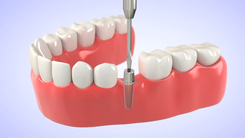 ایمپلنت دندان سه بعدی توسط نور جراحی مولتی مدیا