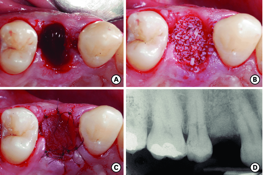 پیوند استخوان کاشت ایمپلنت دندان 