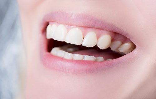 کاشت ایمپلنت دندان استاندارد