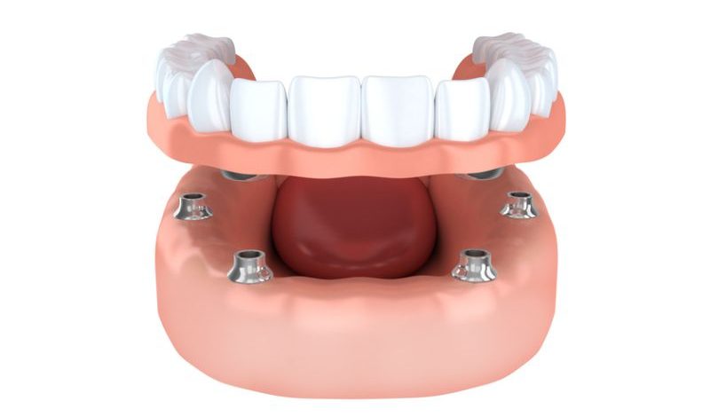 عملکرد ایمپلنت دندان ALL ON 4 ، 6 و 8 