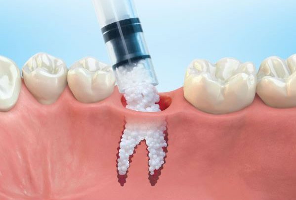 کاشت ایمپلنت دندان ایمن و روند ادغام آن با استخوان