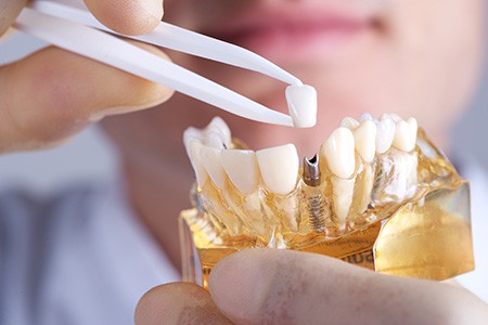 کاشت ایمپلنت دندان عملکرد موثر جایگزین دندان 