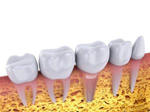 کاشت ایمپلنت دندان هوشمندانه بدون تغییر دندان طبیعی 
