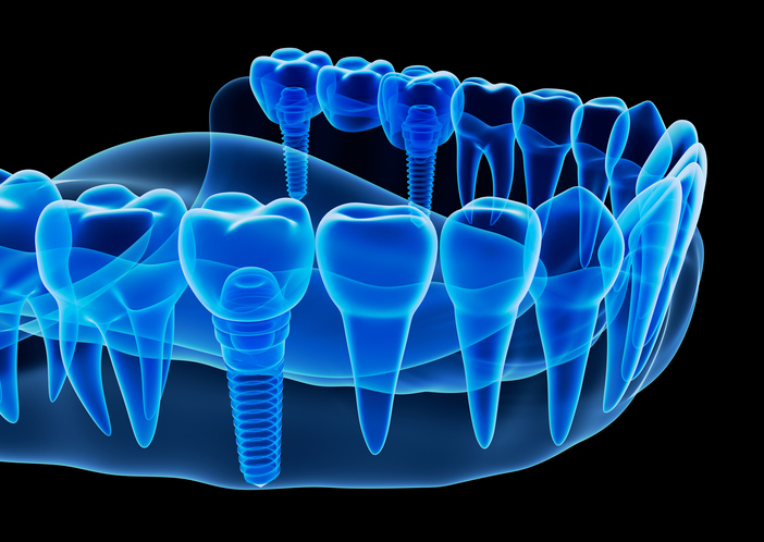 ایمپلنت دندان دیجیتال