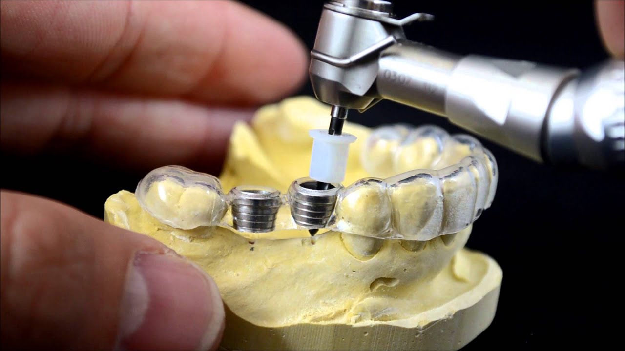 کاشت ایمپلنت دندان با تکنیک های مدرن