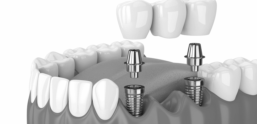 افزایش عمر ایمپلنت بهداشت و مراجعه منظم به دندانپزشک 