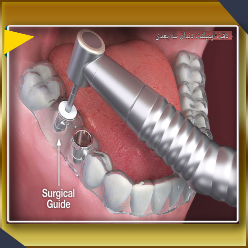 تقسیم برنامه کاری ایمپلنت دندان به روش سه بعدی 