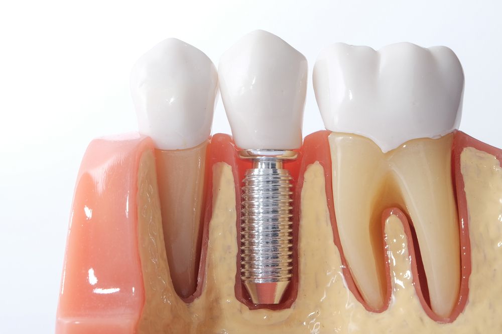 عمل جراحی کاشت ایمپلنت های دندانی و مدت بهبودی