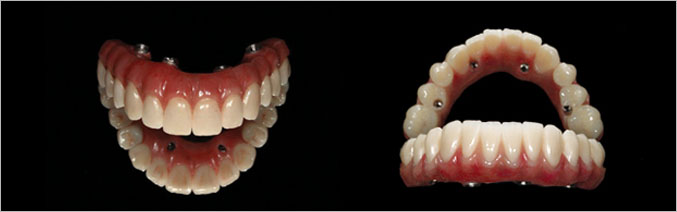 کاشت ایمپلنت دندان یک روزه با روش سه بعدی